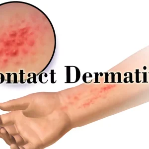 Dr&aacute;ždiv&aacute; kontaktn&aacute; dermatit&iacute;da