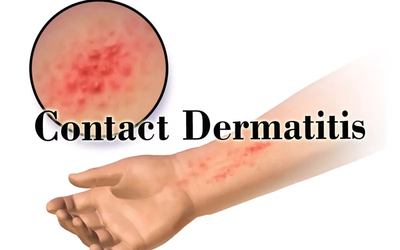 Dr&aacute;ždiv&aacute; kontaktn&aacute; dermatit&iacute;da