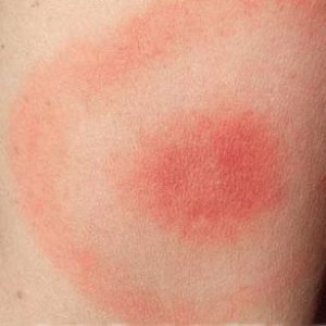 Lymsk&aacute; Boreli&oacute;za