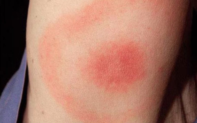 Lymsk&aacute; Boreli&oacute;za