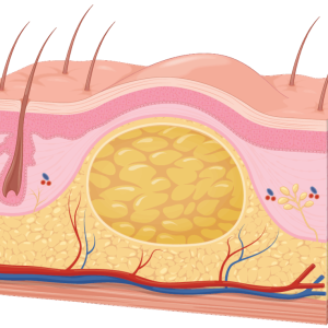 Cesta k bezpečn&eacute;mu odstr&aacute;neniu lip&oacute;mu, krok za krokom